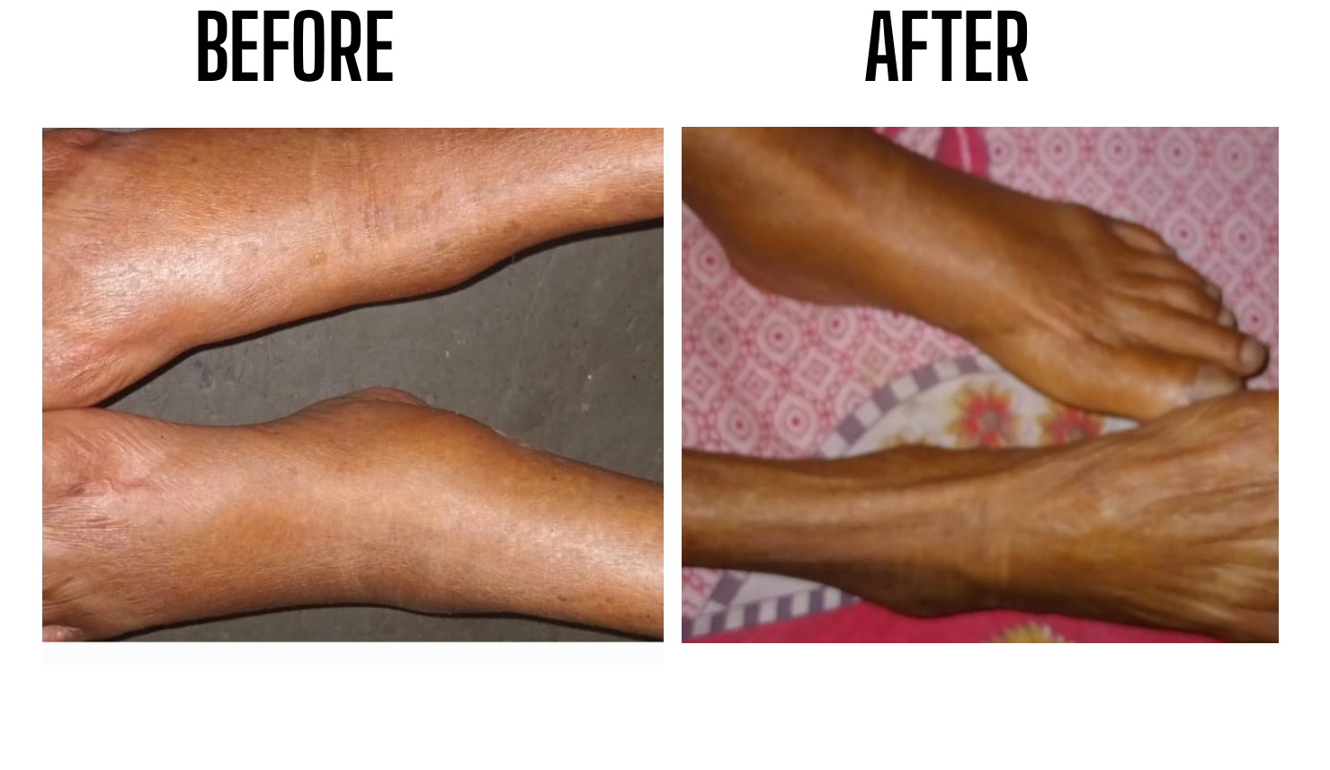 Anxiety neurosis with kidney diseases